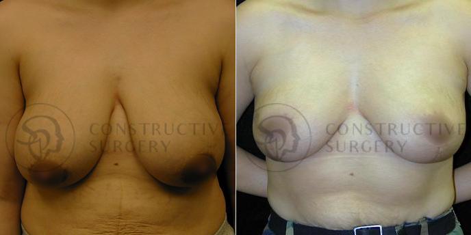 PATIENT-000194  Breast Reduction  Age: 40-49 Gender: Female Ethnicity: White Height: 5'6" - 5'11" Weight: 151-175 lbs.