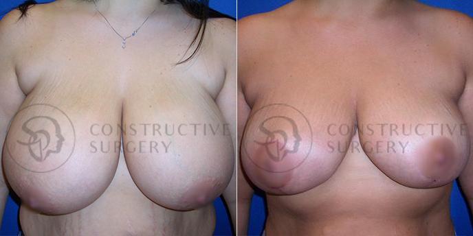 PATIENT-000196  Breast Reduction  Age: 30-39 Gender: Female Ethnicity: White Height: 5'6" - 5'11" Weight: 151-175 lbs.