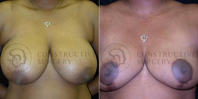 PATIENT-000226  Breast Reduction  Age: 40-49 Gender: Female Ethnicity: White Height: 5'6" - 5'11" Weight: 151-175 lbs.