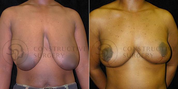 PATIENT-000208  Breast Reduction  Age: 30-39 Gender: Female Ethnicity: Black Height: 5'6" - 5'11" Weight: 151-175 lbs.