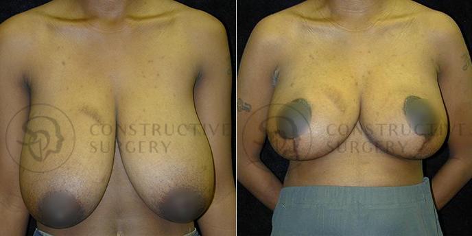 PATIENT-000201  Breast Reduction  Age: 30-39 Gender: Female Ethnicity: Black Height: 5'6" - 5'11" Weight: 151-175 lbs.