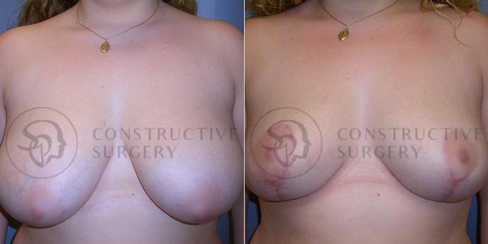 PATIENT-000216  Breast Reduction  Age: 18-29 Gender: Female Ethnicity: White Height: 5'6" - 5'11" Weight: 151-175 lbs.