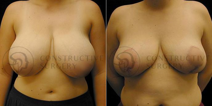 PATIENT-000199  Breast Reduction  Age: 30-39 Gender: Female Ethnicity: White Height: 5'6" - 5'11" Weight: 151-175 lbs.