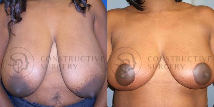 PATIENT-000210  Breast Reduction  Age: 30-39 Gender: Female Ethnicity: Black Height: 5'6" - 5'11" Weight: 151-175 lbs.