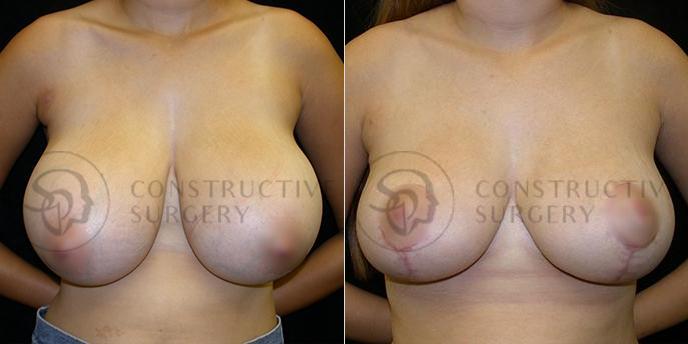 PATIENT-000220  Breast Reduction  Age: 30-39 Gender: Female Ethnicity: White Height: 5'6" - 5'11" Weight: 151-175 lbs.