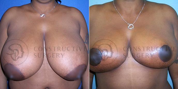 PATIENT-000219  Breast Reduction  Age: 30-39 Gender: Female Ethnicity: Black Height: 5'6" - 5'11" Weight: 151-175 lbs.
