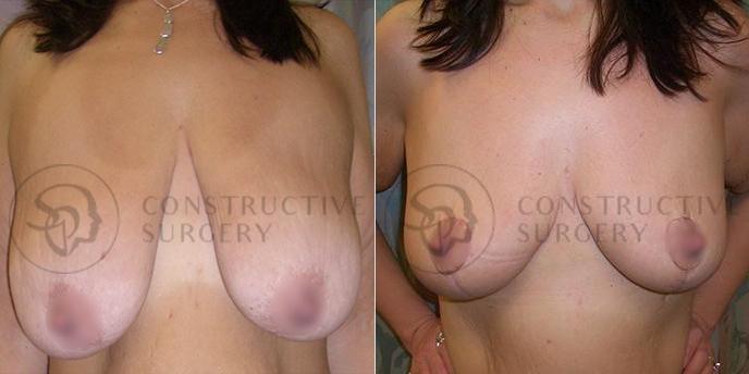 PATIENT-000218  Breast Reduction  Age: 40-49 Gender: Female Ethnicity: White Height: 5'6" - 5'11" Weight: 151-175 lbs.