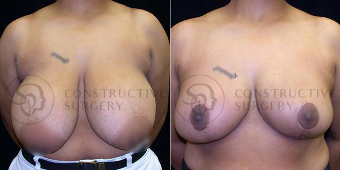 PATIENT-000193  Breast Reduction  Age: 40-49 Gender: Female Ethnicity: White Height: 5'6" - 5'11" Weight: 176-200 lbs.