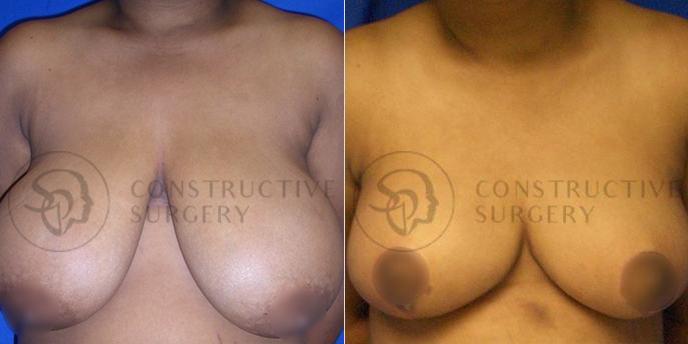 PATIENT-000214  Breast Reduction  Age: 40-49 Gender: Female Ethnicity: Black Height: 5'6" - 5'11" Weight: 176-200 lbs.