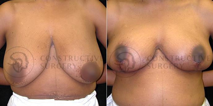 PATIENT-000195  Breast Reduction  Age: 40-49 Gender: Female Ethnicity: Black Height: 5'6" - 5'11" Weight: 151-175 lbs.