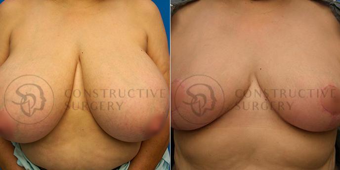 PATIENT-000223  Breast Reduction  Age: 40-49 Gender: Female Ethnicity: White Height: 5'6" - 5'11" Weight: 176-200 lbs.