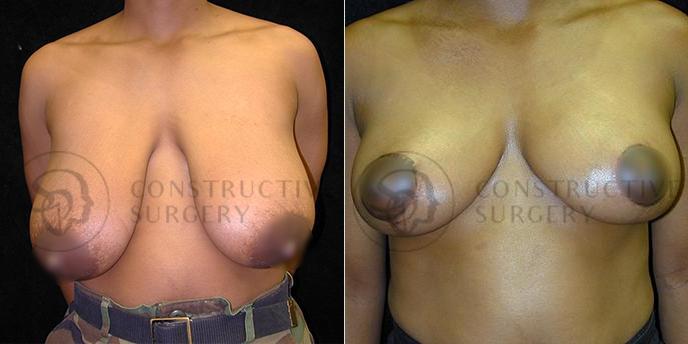PATIENT-000211  Breast Reduction  Age: 40-49 Gender: Female Ethnicity: White Height: 5'6" - 5'11" Weight: 151-175 lbs.