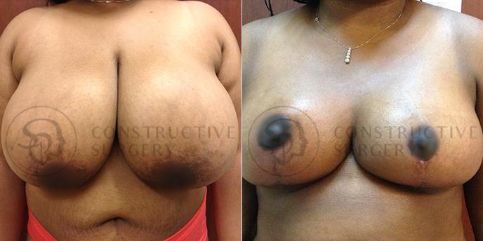 PATIENT-000212  Breast Reduction  Age: 40-49 Gender: Female Ethnicity: Black Height: 5'6" - 5'11" Weight: 201-225 lbs.