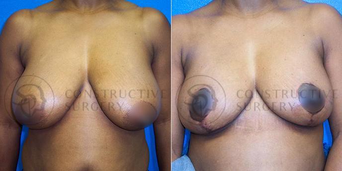 PATIENT-000205  Breast Reduction  Age: 40-49 Gender: Female Ethnicity: Black Height: 5'6" - 5'11" Weight: 151-175 lbs.