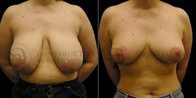 PATIENT-000221  Breast Reduction  Age: 40-49 Gender: Female Ethnicity: White Height: 5'6" - 5'11" Weight: 151-175 lbs.