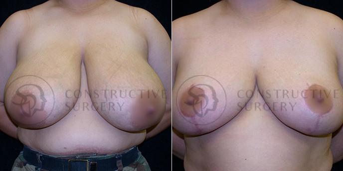 PATIENT-000215  Breast Reduction  Age: 40-49 Gender: Female Ethnicity: White Height: 5'6" - 5'11" Weight: 176-200 lbs.
