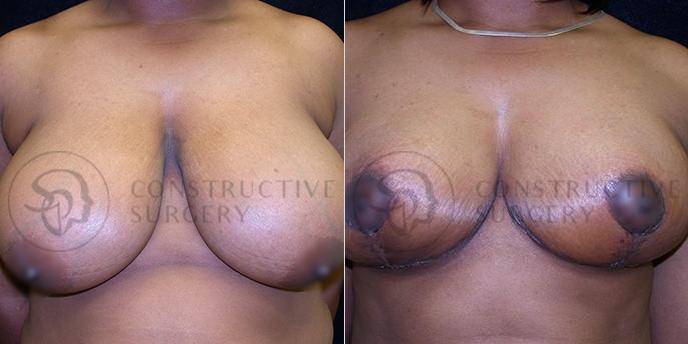 PATIENT-000217  Breast Reduction  Age: 40-49 Gender: Female Ethnicity: Black Height: 5'6" - 5'11" Weight: 176-200 lbs.