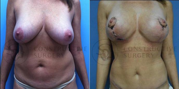 PATIENT-000070  Tummy Tuck, Breast Lift  Age: 18-29 Gender: Female Ethnicity: White Height: 5'0" - 5'5" Weight: 151-175 lbs.