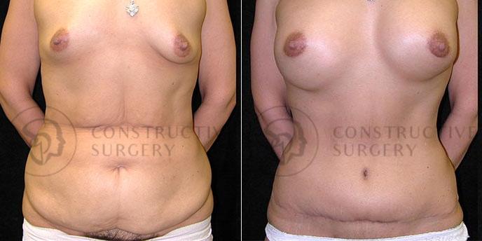 PATIENT-000239  Tummy Tuck, Breast Lift  Age: 40-49 Gender: Female Ethnicity: White Height: 5'6" - 5'11" Weight: 151-175 lbs.